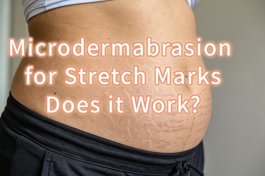 Microdermabrasion Stretch Marks